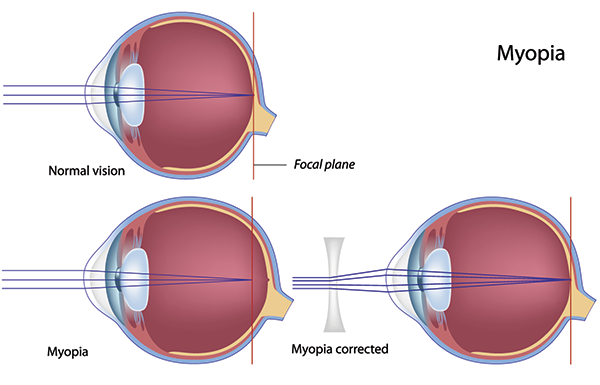 Nearsightedness  treatment