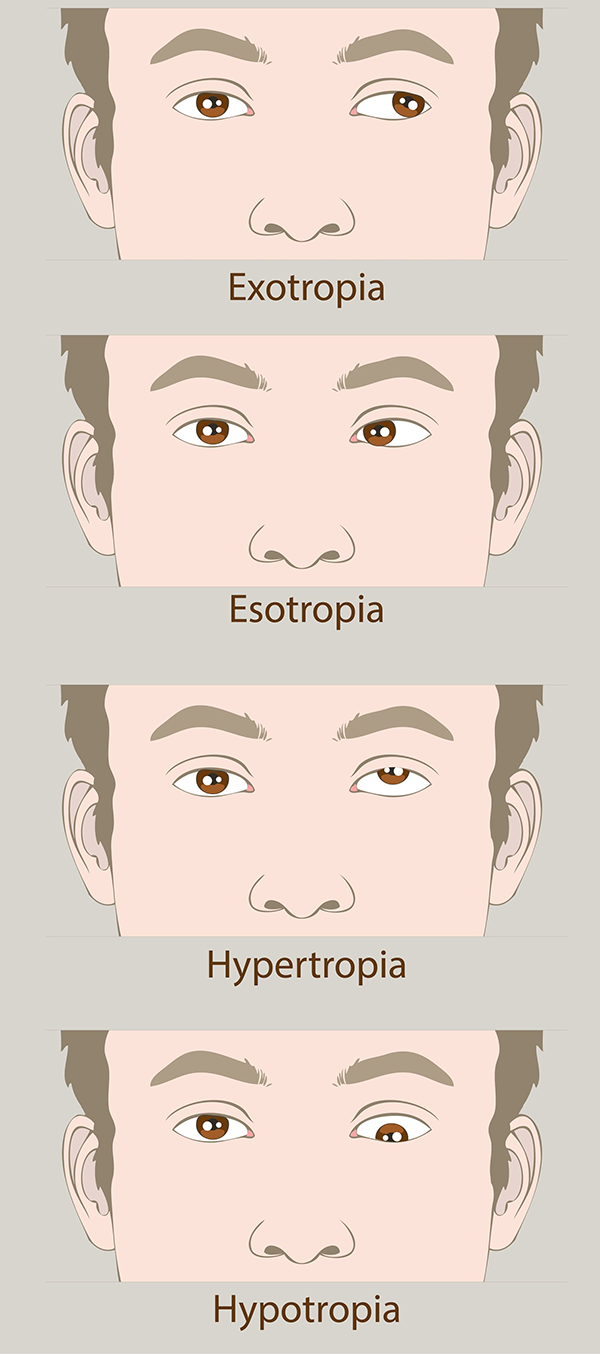 Amblyopia Treatment