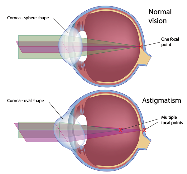 Astigmatism treatment