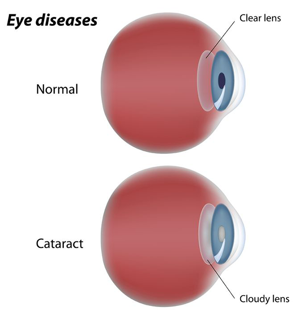 Cataracts treatmen