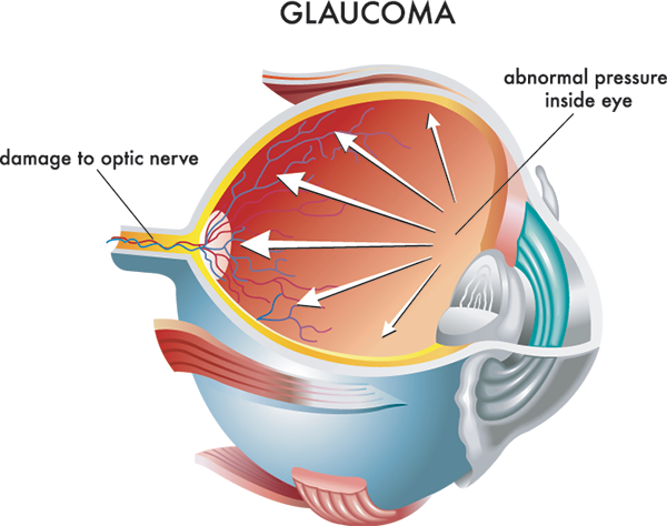 Glaucoma treatrment