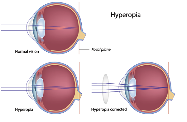 Farsightedness treatment