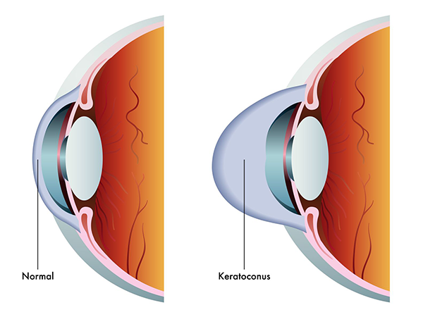 Keratoconus treatment