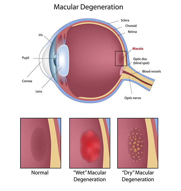 Macular Degeneration treatment