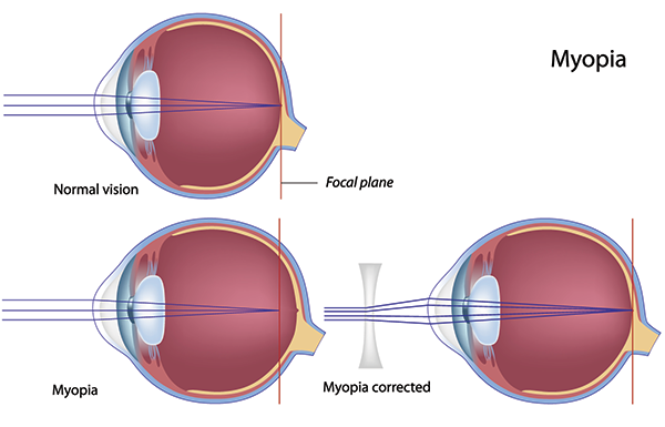 mi a szenilis myopia