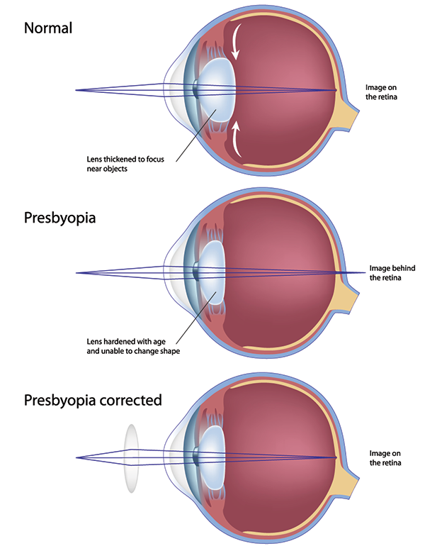 Presbyopia treatment